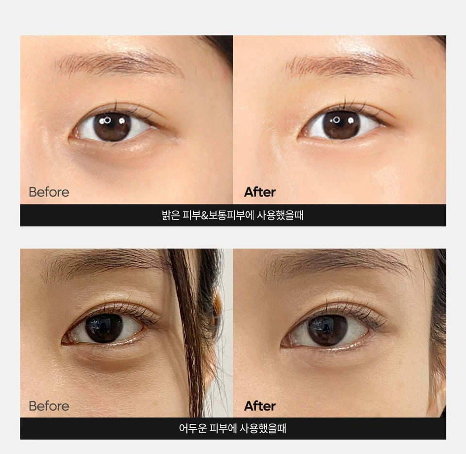 Before and after comparison of eye area treatment on a person's face.