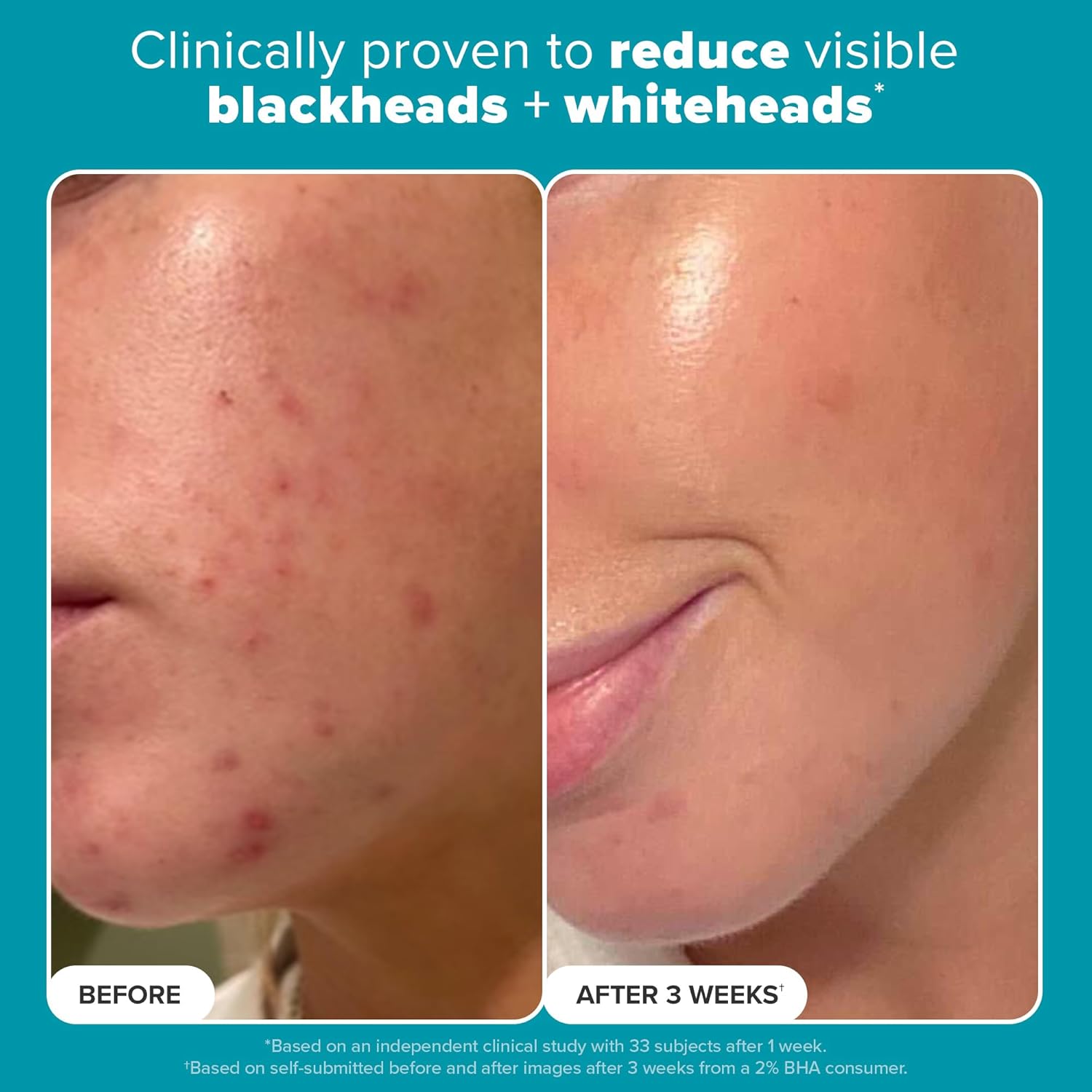 Paula's Choice SKIN PERFECTING 2% BHA Liquid Salicylic Acid Exfoliant-Facial Exfoliant for Blackheads, Enlarged Pores, Wrinkles & Fine Lines 24hrsmart