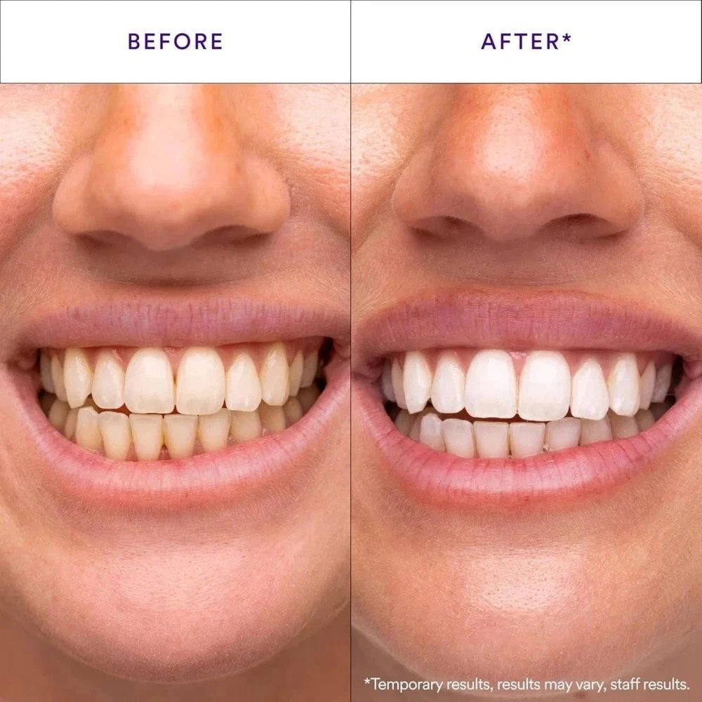 Hismile V34 Teeth Whitening Strips – 14 Pack - 24hrsmart