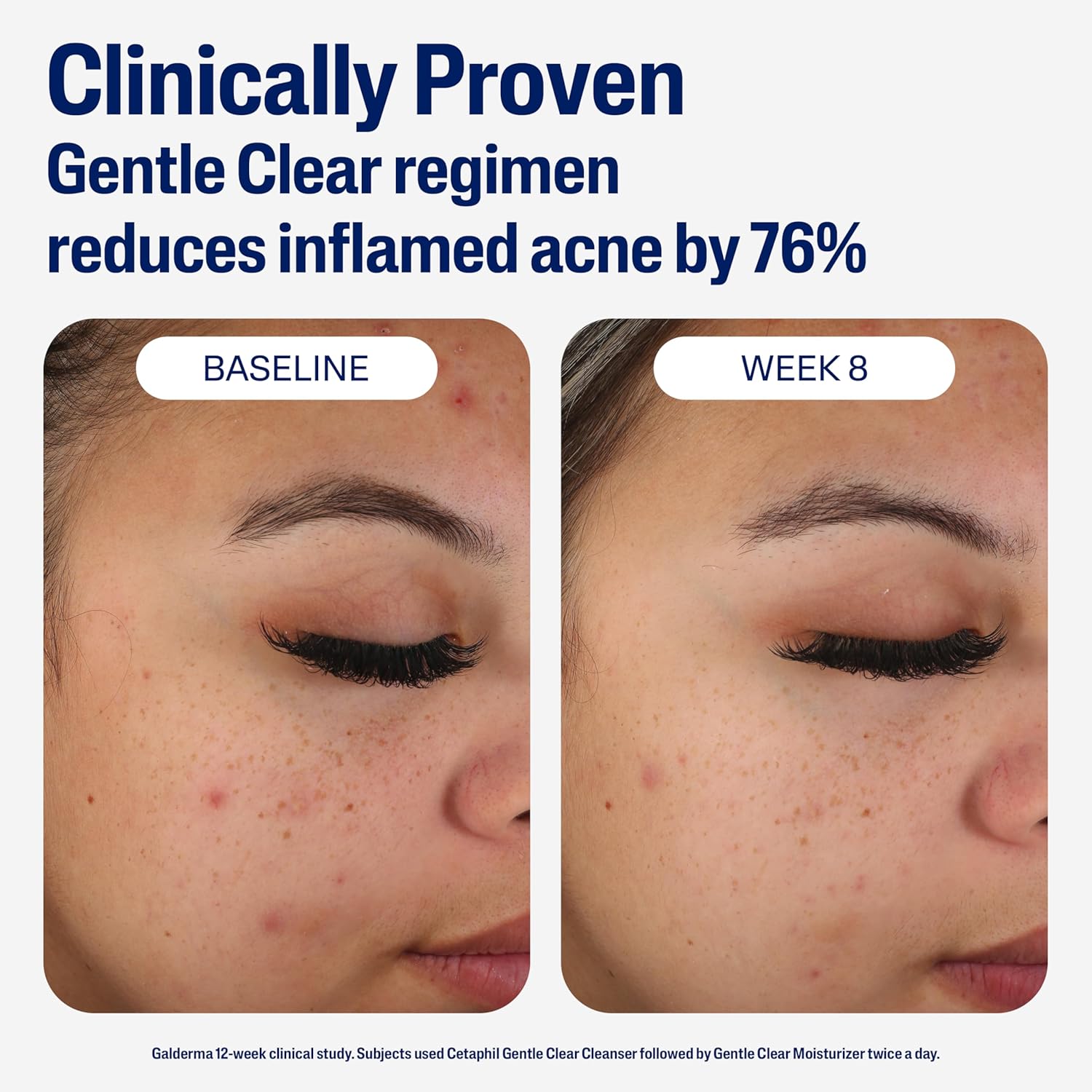 Cetaphil Face Moisturizer, Gentle Clear Mattifying Acne Moisturizer With 0.5% Salicylic Acid, Hydrates and Treats Sensitive Acne Prone Skin, Skin Care for Sensitive Skin, 3oz - 24hrsmart