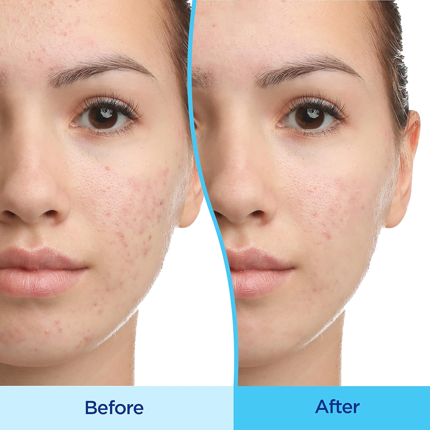 Differin Acne Treatment Gel, 30 Day Supply, Retinoid Treatment for Face with 0.1% Adapalene, Gentle Skin Care for Acne Prone Sensitive Skin, 15g Tube (Packaging May Vary) - 24hrsmart