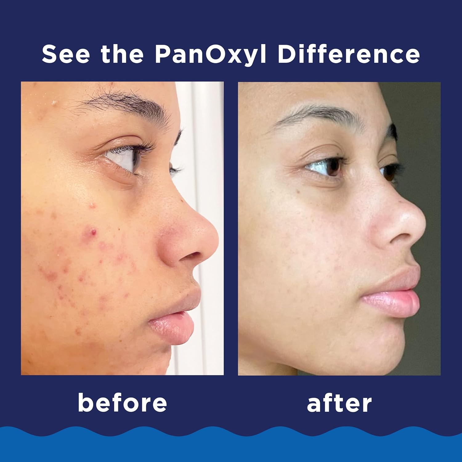 PanOxyl Acne Foaming Wash Benzoyl Peroxide 10% Maximum Strength Antimicrobial, 5.5 Oz - 24hrsmart